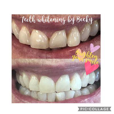 Teeth Whitening By Becky