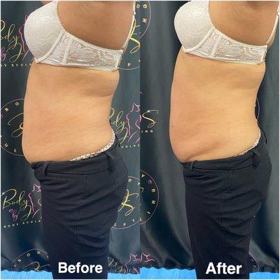 Ultrasound cavitation helps get rid of stubborn fat