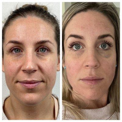 Before and after with two Morpheus treatments. You can see my jaw, cheeks and eyes are less puffy, more sculpted and better complexion.