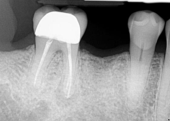 Patient came in for dental implant - this is a before X-ray. Scroll to see after.