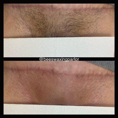 Before and after of a Brazilian wax.