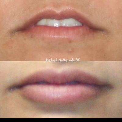 Lip Augmentation by Dr Guttikonda using PermaLip