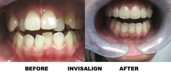 Invisalign