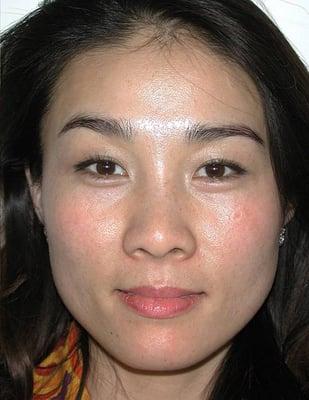 Enhanced Skin Rejuvenation After