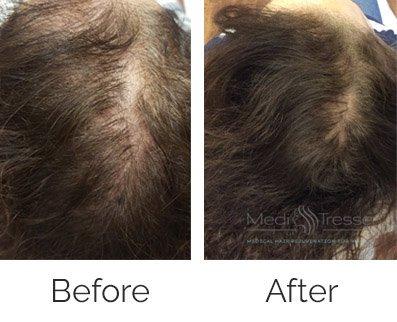 Before & After of PRP Plus 3 Treatments, also used Low Laser Device. 6 Months Post Treatment