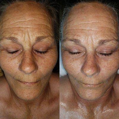 Hydrolifting Facial + Microdermabrasion