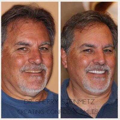 Before and after porcelain veneers by Dr. Sherry Steinmetz