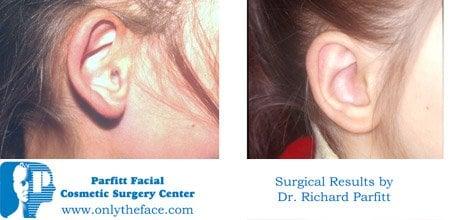 Ear Surgery Madison WI