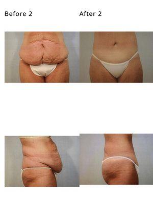 Abdominoplasty Before and After