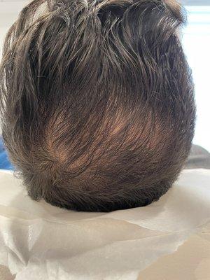 Hair PRP Treatments