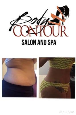 before and after  Body Contour Treatment  1726 nw 36 st #6 Miami, Fl 33142  Tel: 7862547972