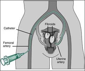 Illustration of Uterine Fibroid Embolization procedure - Memphis, TN