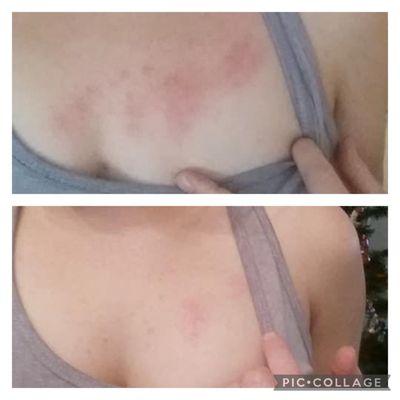 Before and after décolleté treatment