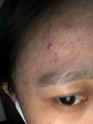 Day 3 after microneedling