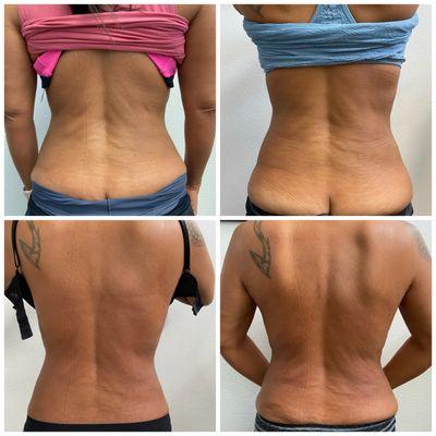 End result Post liposuction using Endermologie