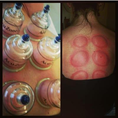 Cupping Therapy