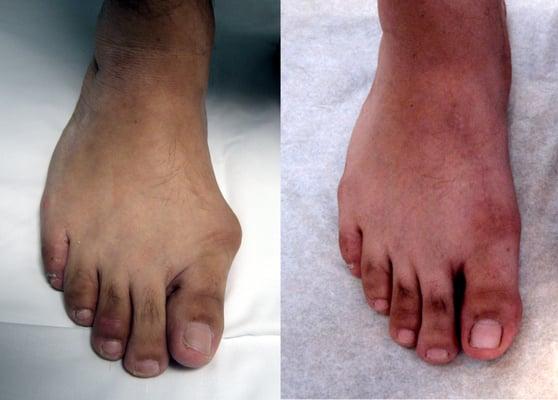 Bunion (Before & After)