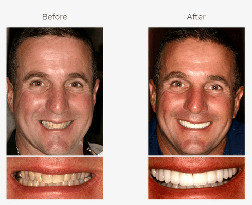 This patient got a great new smile with porcelain veneers and crowns.