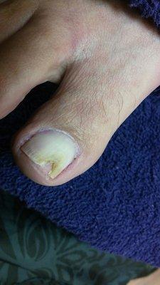 Toenail repair before