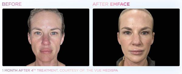 Emface is a non invasive nonsurgical procedure to help lift your face muscles, this procedure helps with jowls, skin laxity and facial aging