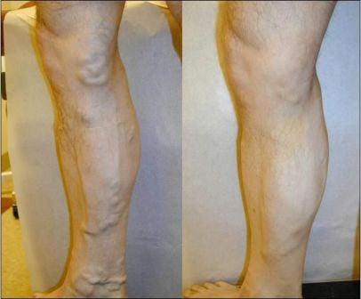 Varicose vein removal in male at Memphis Vein Clinic - Memphis Vascular Center