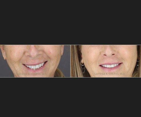 Upper Lip Lift & Liquid Facelift (Voluma & Teoxane RHA) ... Newport Beach female facial plastic surgeon Orange County CA call (949) 644-1400