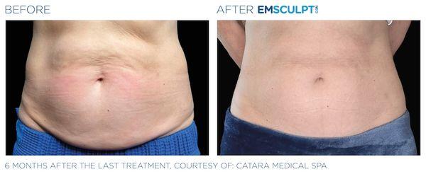 Emsculpt Neo uses innovative technology to help build your muscle by 25% & destroys 30% of fat. Experience 20,000 crunches in 3