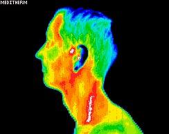 Clogged Carotid Artery-patient had life saving surgery days later.