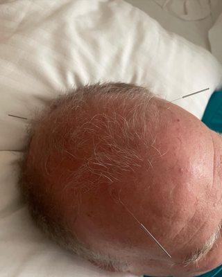 Scalp acupuncture