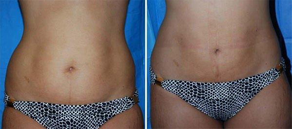 SmartLipo Before & After