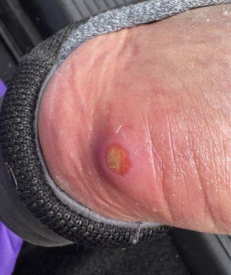 Staphylococcus infection from pedicure