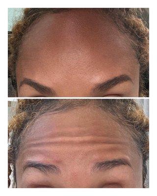 Relax your forehead muscles with Botox or Xeomin