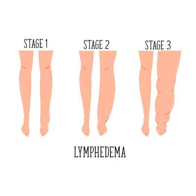 Lymphedema example