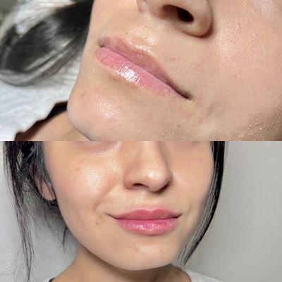 Lip Filler -- Before + After!!