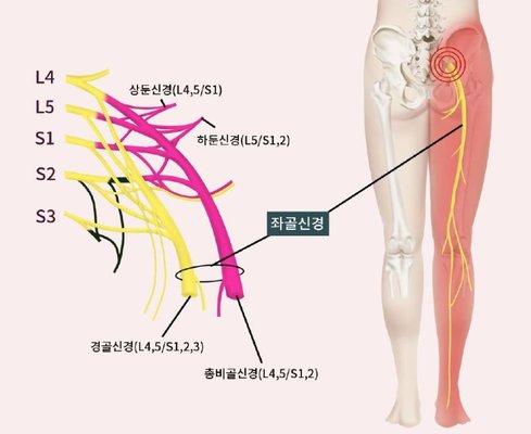 Sciatica treatment And  appeared