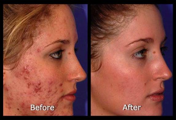 Acne Laser Treatment Before & After