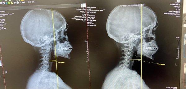 Initial X-ray on the right, 4month follow up on the left!