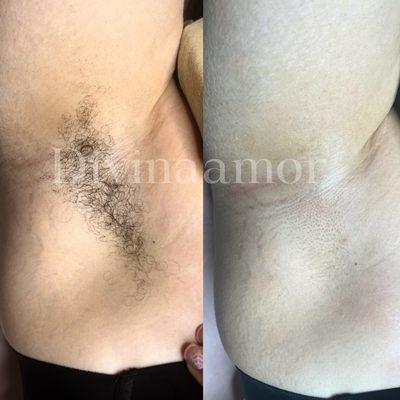 Armpit - Underarm Wax