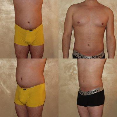 Male Liposuction