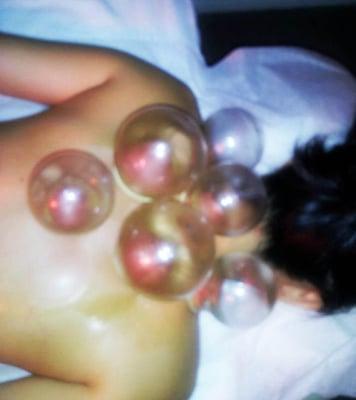 Cupping.