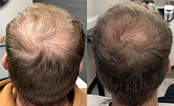 Male Patient after 1 month of treatment