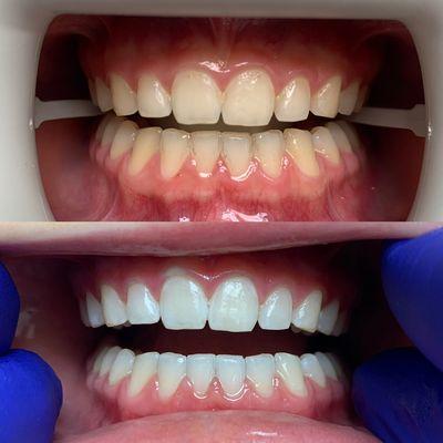 Zoom Whitening Treatment