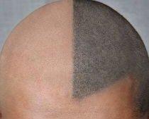 Scalp Pigmentation