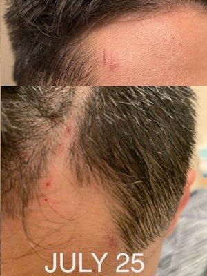 August 25 - 5 days after the initial cut. The cuts in its healing process and the itching stopped.