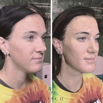 PRXT33 chemical peel without the peeling
Jawline contour to get that SNATCHED look