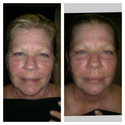 Dermaradiance and smooth sculpt, 1 treatment. Before and after.