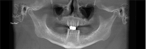 Bone Grafting Severna Park, MD