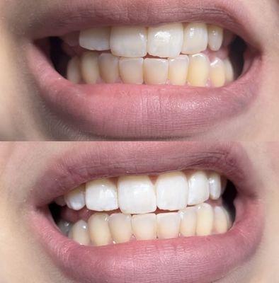 Teeth whitening before & after