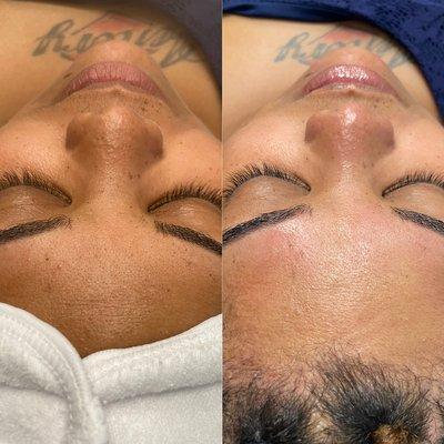 Before and after Signature Facial