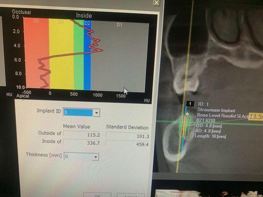 The bone density test. They grafted ultra strong bone.